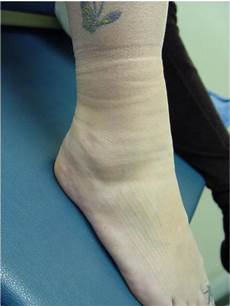 Compression Socks During Pregnancy