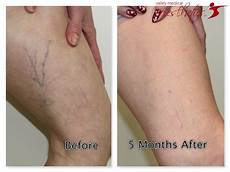Compression Stockings During Pregnancy
