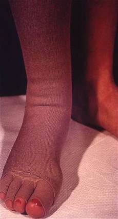 Compression Stockings During Pregnancy
