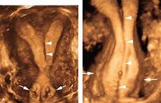 Compression Stockings During Pregnancy